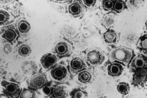 Transmission electron micrograph of herpes simplex virus